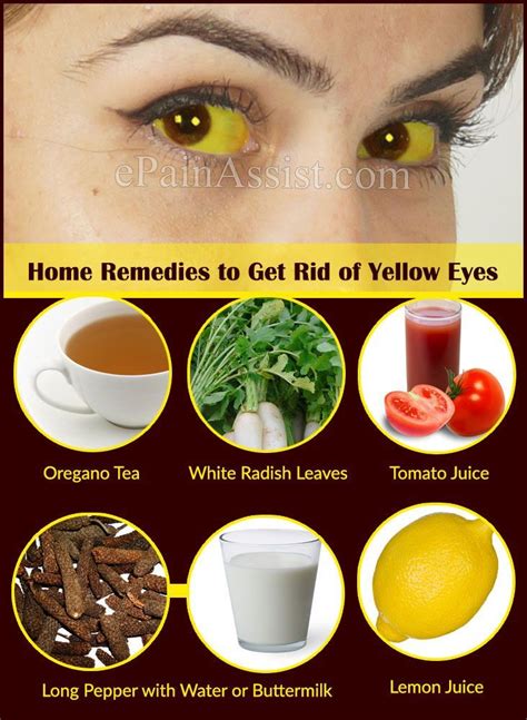 Home Remedies To Get Rid Of Yellow Eyes Yellow Eyes Home Remedies