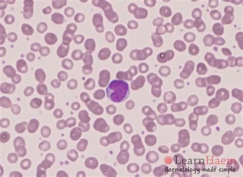 Reactive Lymphocytes Benign Disorders Learnhaem Haematology Made