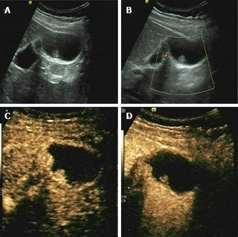 Value Of Contrast Enhanced Ultrasound In The Differential Diagnosis Of