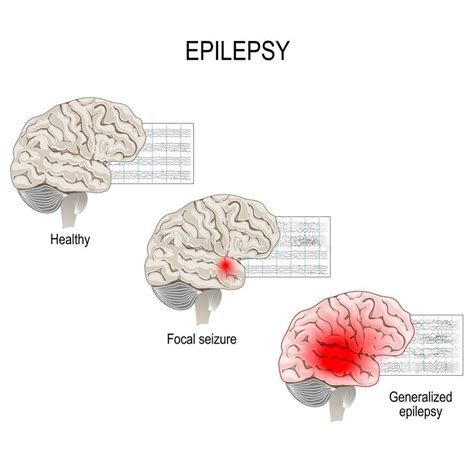 Epilepsy Eeg Of Healthy Brain And Epileptic Seizure Stock Vector