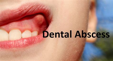 Dental Abscess All You Need To Know About Rrdch