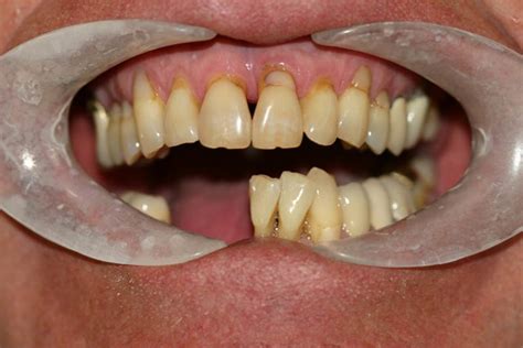 Implant Supported Dentures Caffaratti Dental Group Sparks Nevada