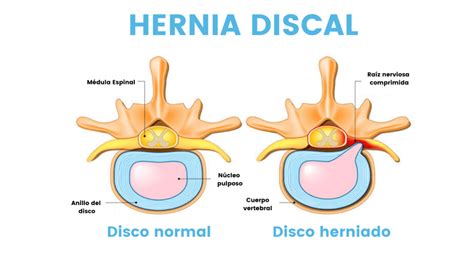 Hernia Discal Y Fisioterpia