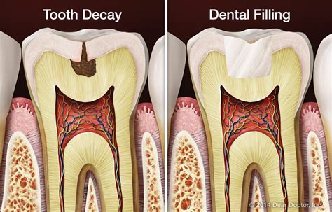 Cavities take their toll in many ways. Dental Fillings in Vadodara | XL Smiles Dental Clinic