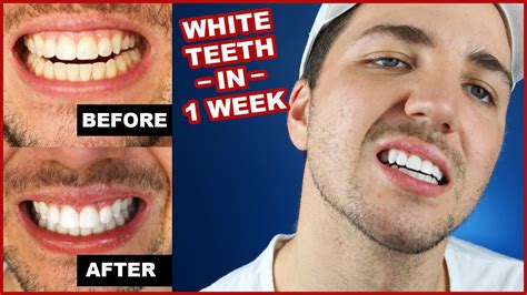 How To Get White Teeth In 1 Week Smile Brilliant Youtube