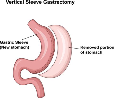 5 Gastric Bypass Surgery Diagrams
