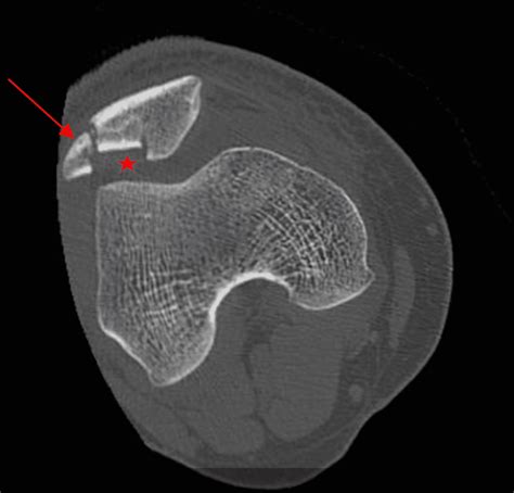 Cureus Vertical Patella Fracture Fixed By Plate And Screws With Bone