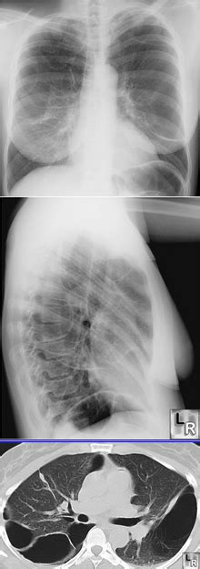 Bullous Disease Of The Lungs Conventional Radiograph And Ct Frontal
