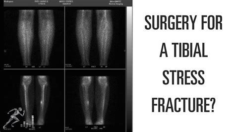 Can A Tibial Stress Fracture Heal Without Surgery Youtube