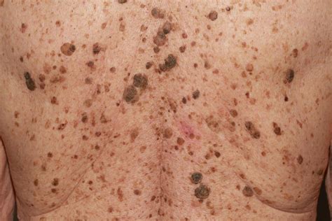 How To Remove Skin Keratosis At Home Seborrheic Keratosis Simply