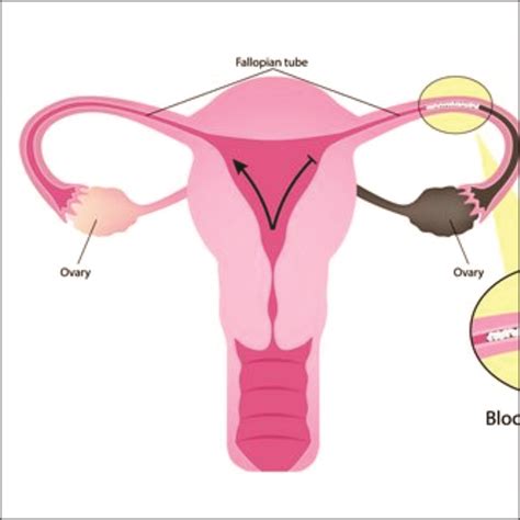 Tubal Blockage Fallopian Tube Obstruction Women S Clinic