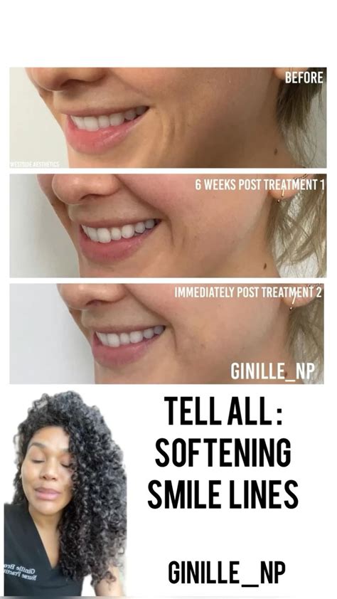 Softening Smile Lines With Filler Smile Lines Injections Before And
