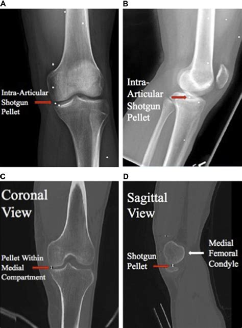 Left Knee Radiographs And Computed Tomography Scans A Download