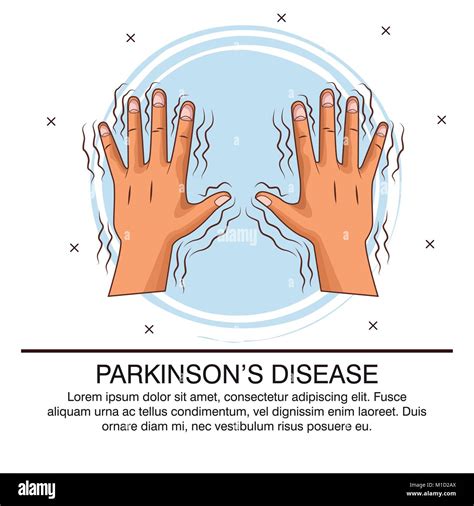 Parkinsons Disease Infographic Stock Vector Image And Art Alamy