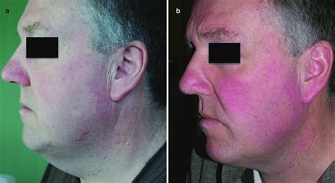 25 A Pre Operative Profile View Showing Excess Skin Slight Jowling