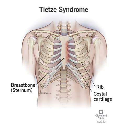 Tietze Syndrome Causes Symptoms And Treatment