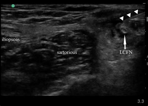 Lateral Femoral Cutaneous Block — Highland Em Ultrasound Fueled Pain