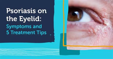 Psoriasis On The Eyelid Symptoms And 5 Treatment Tips Mypsoriasisteam