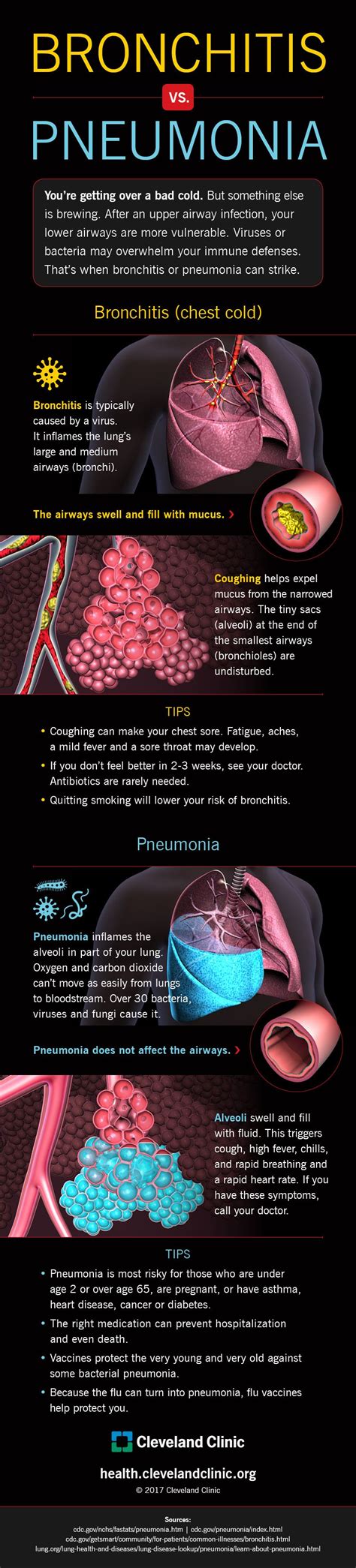 Feeling Lousy How To Tell If Its Bronchitis Or Pneumonia Infographic