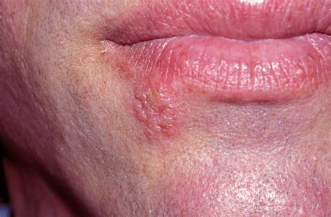 Erythema Lips