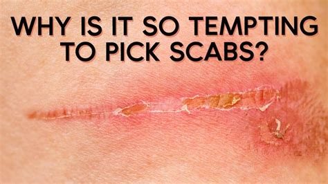 Why Is It So Tempting To Pick Scabs Skin Picking Disorder Layers Of