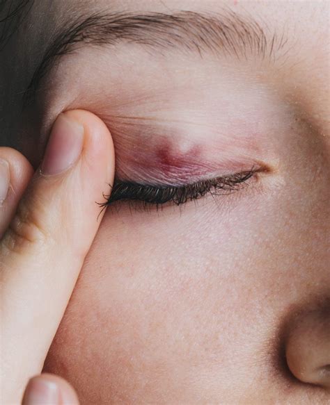 Get Rid Of A Stye Or Chalazion Incision Curettage Treatments
