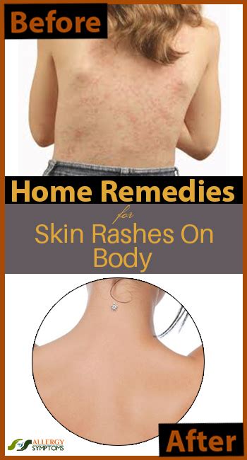 This, in turn, speeds up the healing of your skin from an allergy. Home Remedies for Skin Rashes on Body - Allergy Symptoms
