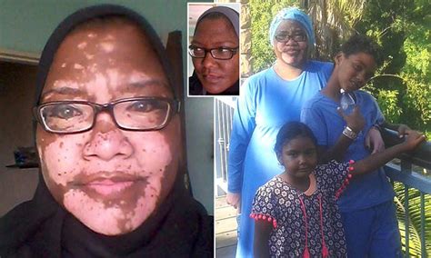 South African Woman With Severe Vitiligo Posts Her First Ever Selfie