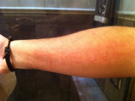 Dermatographia Skin Writing On The Arm Writing Pictures Urticaria Skin
