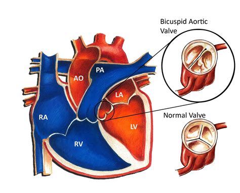 Anatomy Of Bicuspid Aortic Valve