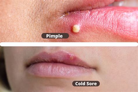 Difference Between Pimple And Cold Sore Skincare Tips