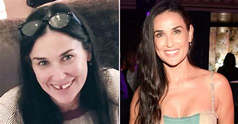 Demi Moore Reveals She Lost Two Front Teeth To Stress One Of The