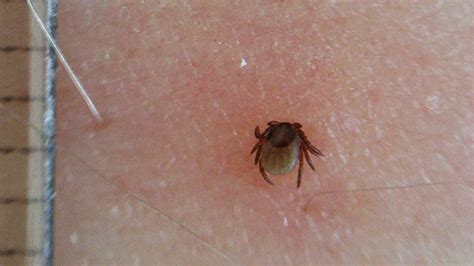 It affects over 2,000 people a year in the u.s. Rocky Mountain Spotted Fever: Pictures and Long-Term Effects