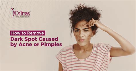 How To Remove Dark Spot Caused By Acne Or Pimples Skin Solutionz