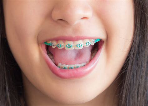 Need kids' braces advice? Read this | HoneyKids Asia