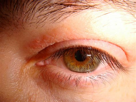 Eyelid Yeast Infection Symptoms Guide