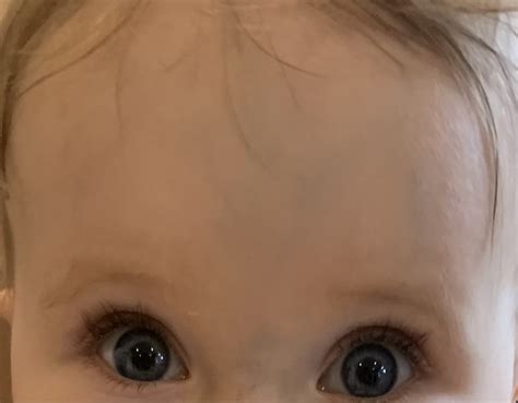 Very Prominent Veins On 85 Month Olds Forehead Mumsnet