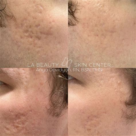 Morpheus8 La Beauty Skin Center