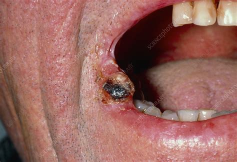 Squamous Cell Carcinoma Of The Lip In A Man Stock Image M1310239