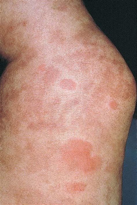 Vasculitis Of The Skin Pictures