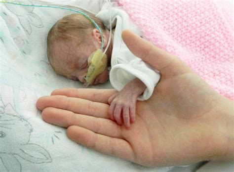 Premature Baby Weighing Less Than A Bunch Of Grapes Goes Home Two Weeks