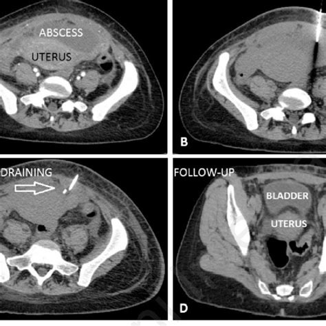 ct transversal imaging of abscess formation in front of uterus a download high
