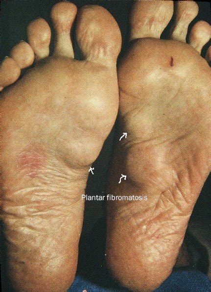 Plantar Fibromatosis Causes And Treatment Options