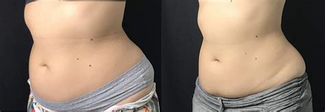 Miami Coolsculpting Before And After Photos Cool Medspa Miami