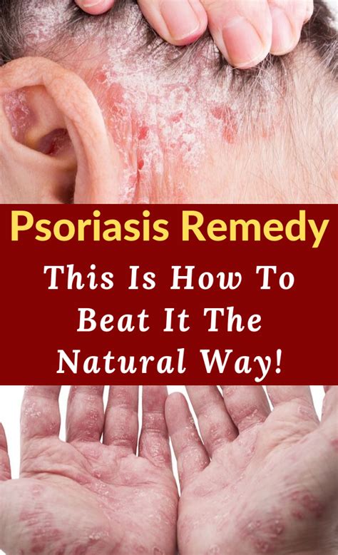 Psoriasis Remedy This Is How To Beat It The Natural Way Psoriasis