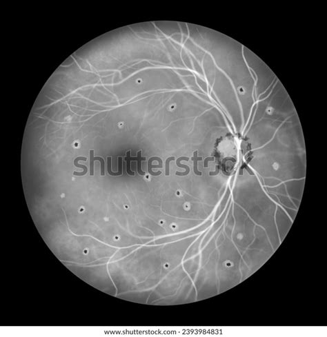 Retina Presumed Ocular Histoplasmosis Syndrome Seen Stock Illustration