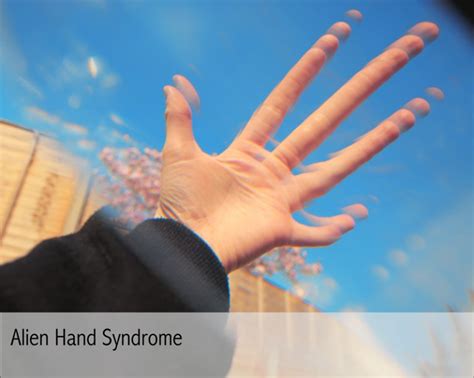 alien hand syndrome 4sight vision support
