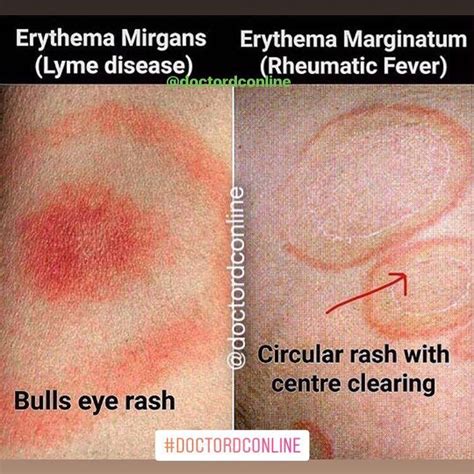 Erythema Migrans Refers To The Rash Often Though Not Always Seen In