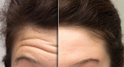 Forehead Lines Mclean Va And Woodbridge Va Skin And Laser Dermatology