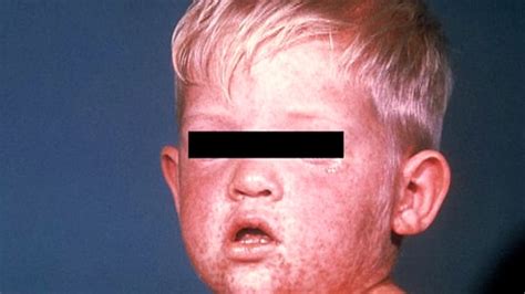 Measles Cases Surge In Us Fueled By Unvaccinated Travelers